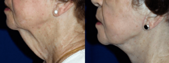 Before & after photos of a Lower rhytidectomy which includes bands plus tightening jowls.